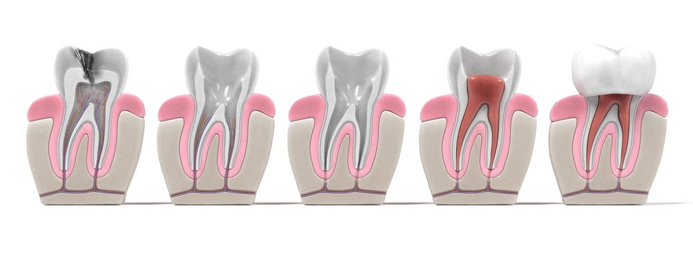 endodontie