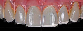 fatete dentare 2
