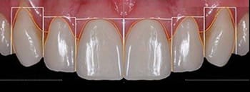 fatete dentare 3