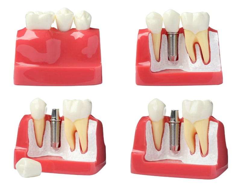 Procedura de implantare dentara